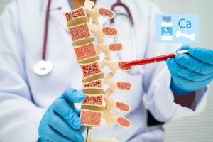 Osteoporosi: il minerale essenziale che non deve mancare